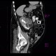 Pyonephros, renal stones, casting, staghorn calculus, nephrolithiasis: CT - Computed tomography